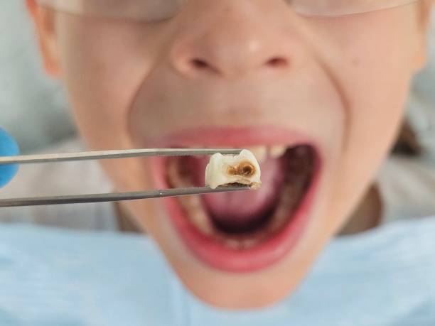 Best Broken Tooth Emergency  in Putney, GA